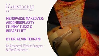 Menopause Makeover Tummy Tuck & Breast Lift Long Island, New York by Dr. Kevin Tehrani