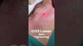 new helix co2 resurfacing laser(coolpeel)#removes damage skin#smooth or scars#skin tone#sun damage