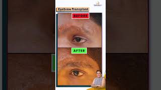 Eyebrow Hair Transplant: Stunning Before & After Transformation! at Tamira