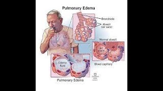 ACUTE PUMONARY EDEMA@doctoronline-nk3rz