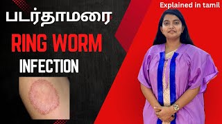 படர்தாமரை (Ring Worm Infection) - Explained | Why it occurs? How to treat? | நோயை பற்றி அறிவோம்