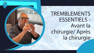 TREMBLEMENTS ESSENTIELS - Avant la chirurgie/ Après la chirurgie #neuromodulation #shorts