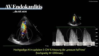 〖Echokardiografie〗 Aortenklappenendokarditis bei i.v. Drogenabusus 🫀