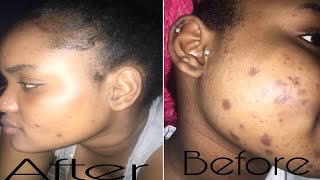 SKIN CARE ROUTINE| HOW I GET RID OF DARK SPOTS acne 😔