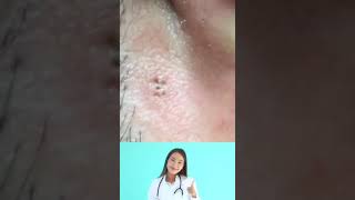 Dr.Nattacha, blackheads,acne, extraction.