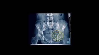 How to measure with the Hip Dysplasia Pro App from i-tunes