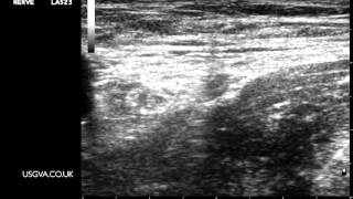 Ultrasound Guided Femoral Nerve Block (Out of Plane Technique)