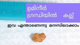 #salivarystone #dranagha #dentalks Salivary Stones Explained In Malayalam | Dr. Anagha