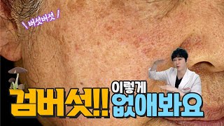 팔과 얼굴에 있는 검버섯 치료해볼까??