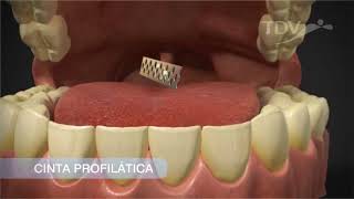 Cinta Profilática TDV   Remoção de tártaro1