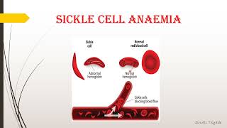 one gene one polypeptide theory - Sickle Cell Anaemia by Sonali Tayade