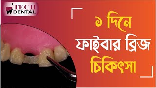 মাত্র ১ দিনে ফাইবার ব্রিজ চিকিৎসা  ।।  Fiber bridge treatment in just 1 day  ।। Tech dental