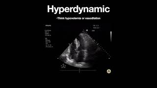 Hyperdynamic Left Ventricle (Apical)