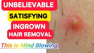 Satisfying Ingrown Hair Removal | Mind Blowing Ingrown Hair