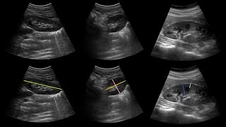 Buyrak va siydik yo'llari xastaliklari ultratovush tashxisoti. Buyrak UTT. УЗИ почек.