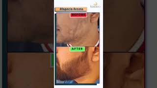 How to Treat Alopecia Areata: Proven Solutions and Result