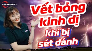 Sét đánh cảm giác thế nào? Người bị sét đánh kể lại khiến ai cũng LẠNH NGƯỜI - Chống sét VN