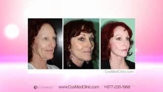 Face Lift Mexico  -  Before & After Photos of Facial Rejuvenation from CosMed Plastic Surgery Center