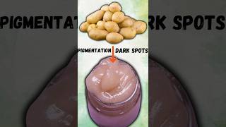 Potato to treat skin pigmentation, dark spots, acne scars #potatocream #shortsindia #trending