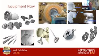 Approach to Acetabular Metastasis