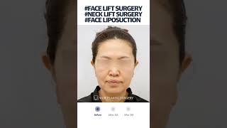 [B&A] Face, Necklift at V.LIF Plastic Surgery Korea #shorts