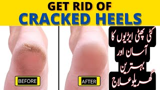 Get Rid of Cracked Heels Just in One Night | No more Heel Cracks | Cracked Heels Healthcare Remedy