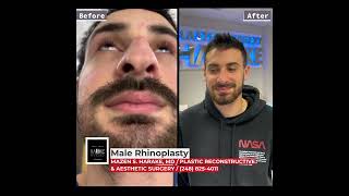 Male Rhinoplasty