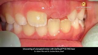 Uncovering of unerupted incisor with LiteTouch™ Er:YAG laser