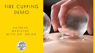 Fire Cupping Demo for 2021 Acupuncture & Oriental Medicine Day