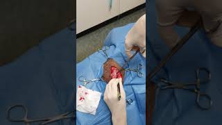 Lipoma removal