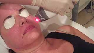 Fraxel Laser Resurfacing at Jardin Medical Spa in Philadelphia