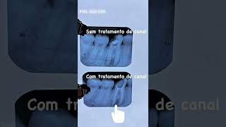 Radiograficamente como é um tratamento de canal. Yamar Odontologia Londrina.