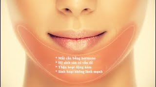 Seri Nặn Mụn-Part 10 Trị mụn đầu đen vùng cằm