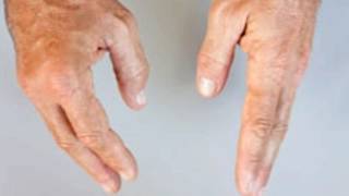 Swollen Finger Joints