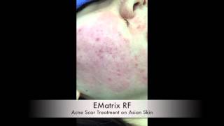 Top Treatment for Acne Scars on Asian Skin