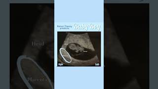 How To predict Boy baby in Scan report Part 2   #Ramzi theory #Shorts  #Baby and Mother care