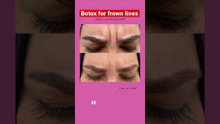 Botox for frown lines. #botox #cosmetics #beautiful #foryou #dr-bakr