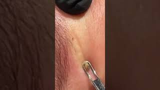 blackheads removal