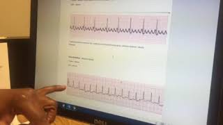 Tele Tip: afib and aflutter