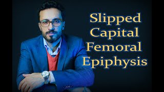 06 Slipped Capital Femoral Epiphysis