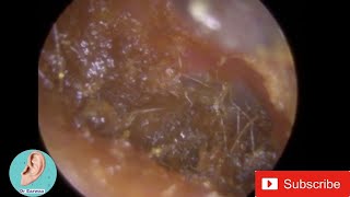 Ear Wax Removal with Jobson Horne and Suction revealing MIDDLE EAR EFFUSION