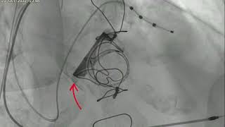 Dr Malik performs a Transcatheter Valve: MITRAL Valve-in-Valve TAVI shown at IVCC 2022