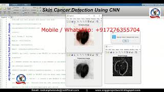 Skin Cancer Detection Using CNN | Skin Cancer Classification Using Matlab | Melanoma Detection