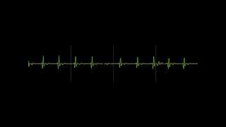 ECG Signal