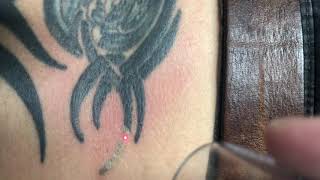 Laser tattoo removal lower back Raleigh