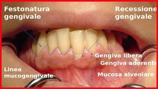 8 rimedi naturali che riparano recessione gengivale- Italy365