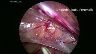 laparoscopic pediatric hernia repair in 2 yrs boy with 3 mm instruments