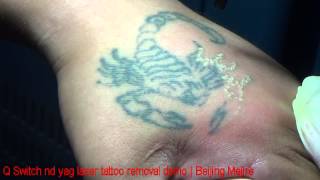 Mejire Q Switch Nd yag laser tattoo removal demo 1