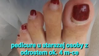 pedicure u seniora z odrostem ok. 4mce #podologia @podopogotowie #podology