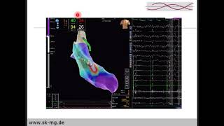 Ablation Strategies in patients with VT AF  Dr  Noureddin Sawan